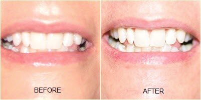 Before and after whitening